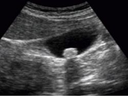 Ultraschall der Galle