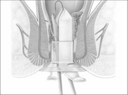 Zeichnung einer Hämorrhoiden OP