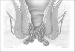 Hämorrhoiden Schweregrad 3