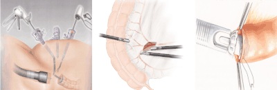 Minimalinvasive Divertikeloperation Sigmaresektion