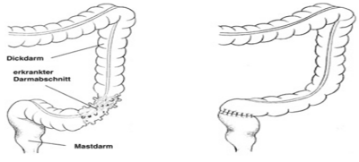 Offene Divertikeloperation Sigmaresektion